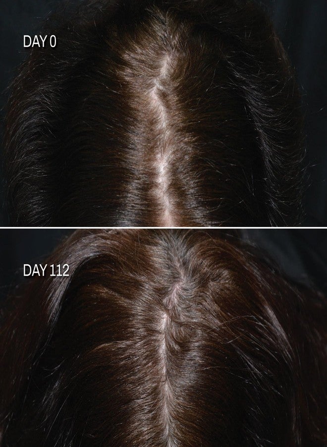 Avantic VitalGrow Postpartum Hair Loss Serum – Clinically Proven Hair Growth Treatment to Boost Density, Restore Pigmentation & Nourish Scalp - Image 3