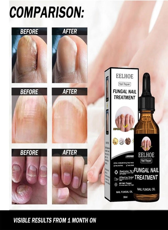 EELHOE Toenail Fungus Treatment Extra Strength – Nail Fungal Oil with Glycerin & Panthenol, 4 Pure Natural Plant Extracts, Fung Damaged Nails, Discoloration Nails, Nail Psoriasis, Nails Aging, 50ml - Image 5