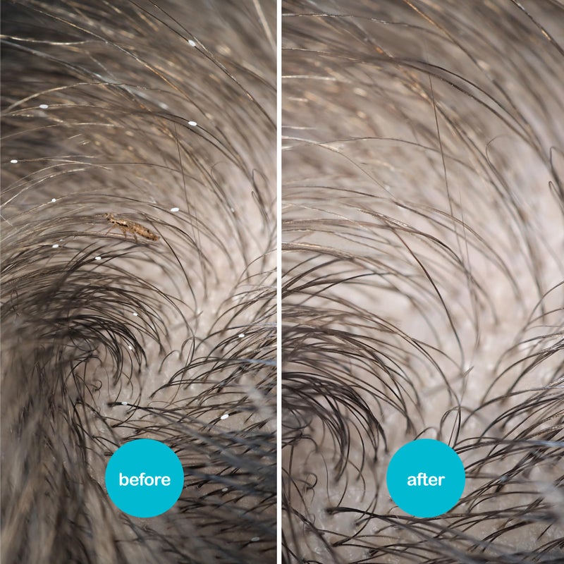 NitWits All-in-One Head Lice Treatment Spray, Kills Lice, Super Lice & Eggs, Includes Lice Spray 120ml & Lice Comb, Lice Treatment for Kids & Adults - Image 5