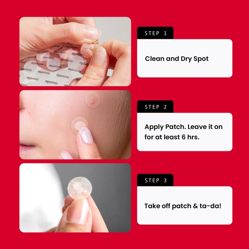 AVARELLE Acne Pimple Patch (40 Count) Absorbing Hydrocolloid Spot Treatment with Tea Tree Oil, Calendula Oil and Cica, Certified Vegan, Cruelty Free (VARIETY / 40 COUNT) - Image 5