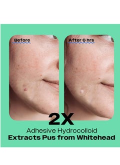 AVARELLE Avarelle Acne Pimple Patch (40 Count) Absorbing Hydrocolloid Spot Treatment with Tea Tree Oil, Calendula Oil and Cica, Certified Vegan, Cruelty Free (VARIETY / 40 COUNT)  - Image 3