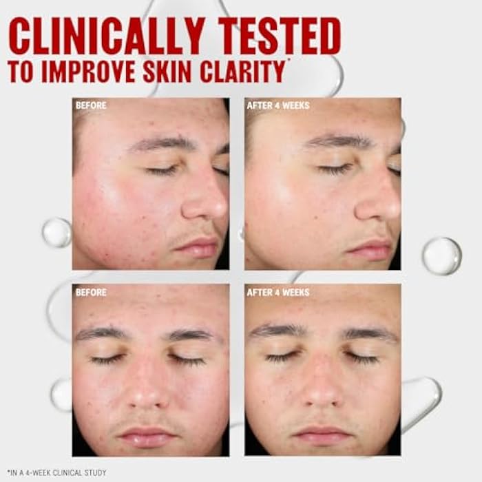 Thayers Blemish Clearing Salicylic Acid Toner, Acne Treatment Face Toner with 2% Salicylic Acid, Soothing and Non-Stripping Skin Care, 12 Fl Oz - Image 5