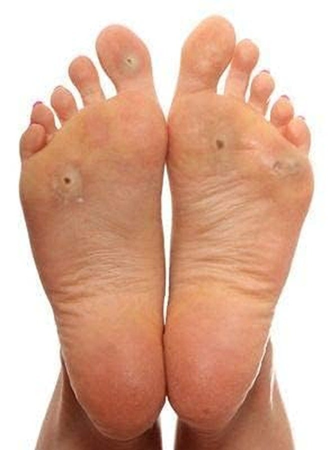 Laxminarayan Ayurvedic Foot Corn/Hand Corn Remover, Callus Remover, Kapasi Remover Cream/Malam - Image 5