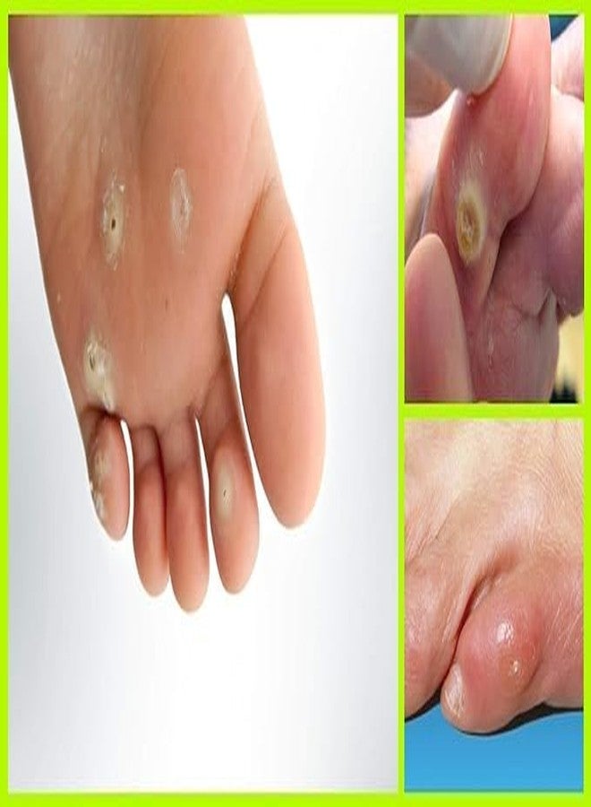 Laxminarayan Ayurvedic Foot Corn/Hand Corn Remover, Callus Remover, Kapasi Remover Cream/Malam - Image 2