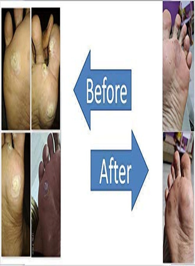 Laxminarayan Ayurvedic Foot Corn/Hand Corn Remover, Callus Remover, Kapasi Remover Cream/Malam - Image 3