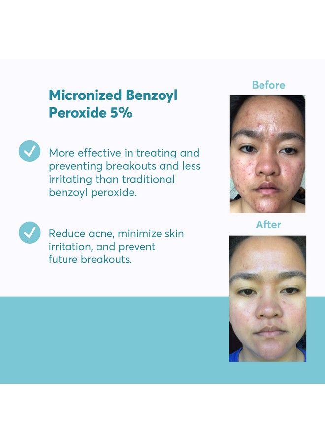 MDacne Acne Treatment Cream With 5% Benzoyl Peroxide Unclog Pores Reduces Blemishes & Enhanced With Plantbased Ingredients For Sensitive Skin - Image 4