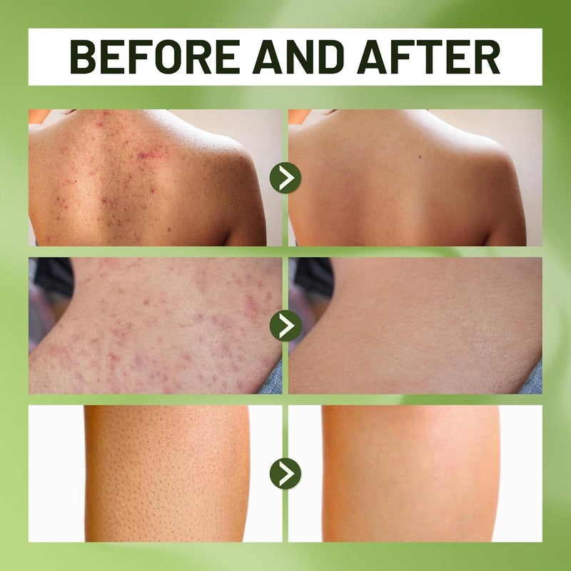 ABERA Folliculitis BHA Shower Gel HighPerformance Folliculitis Body Wash Wild Bitter Melon Extract Reduces Back Acne Hyperkeratosis1014 fl oz - Image 4