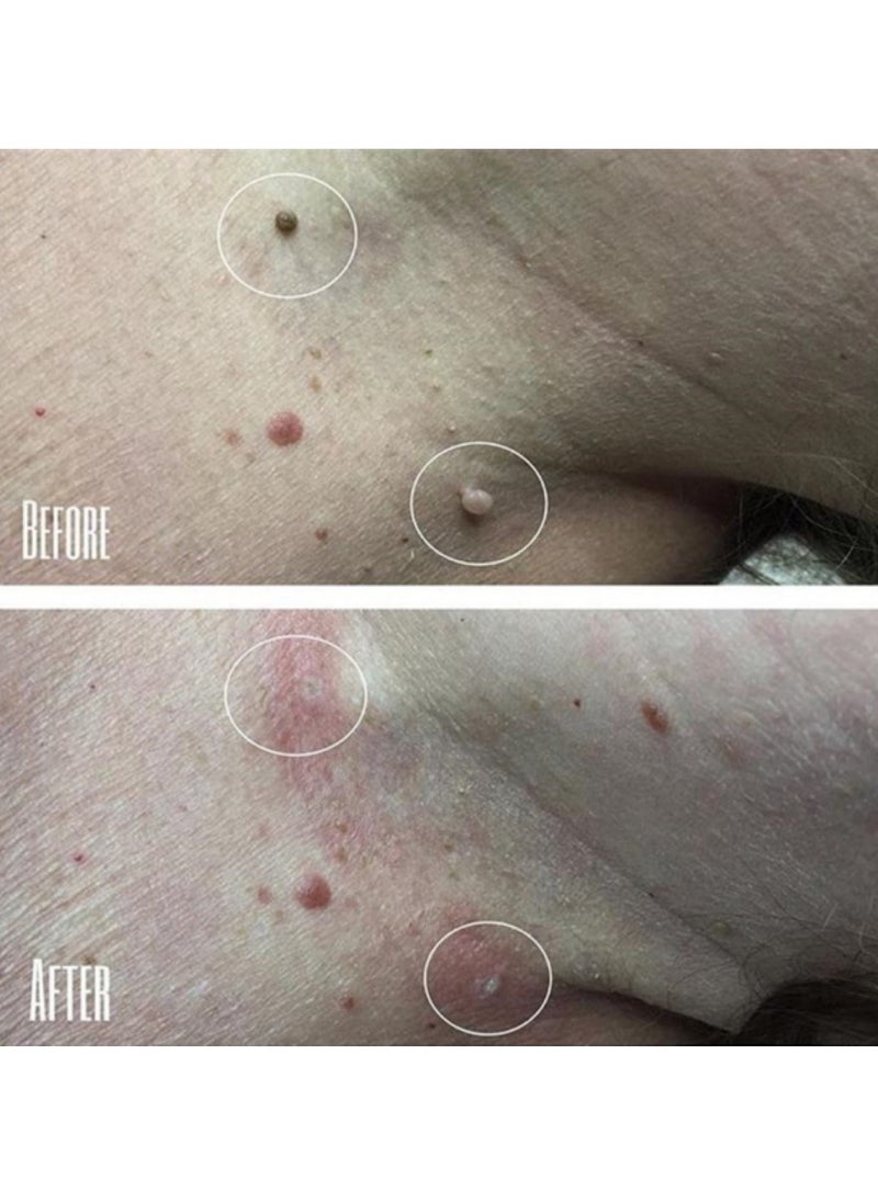 iBealee Wart Removal Essential Oil A Gentle Safe With Natural Extracts For All Skin Types Universal For Both Men And Women  - Image 2