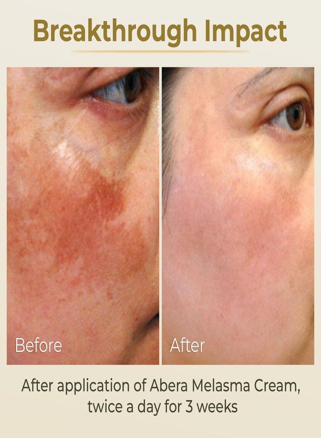 ABERA Melasma Cream, Dark Spot Corrector - Melasma, Freckle, Sun Spot, Age Spot Remover Advanced Formula for Women and Men (0.7 Oz Per Item) - Image 4