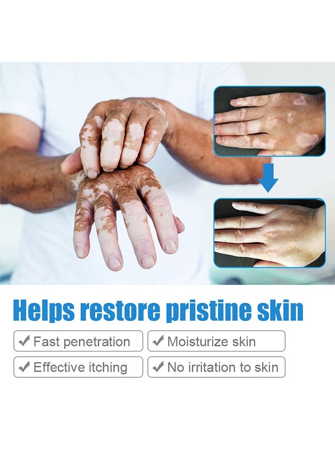 LANEMAY Vitiligo Ointment, Vitiligo Care Cream for Skin Vitiligo, Psoriasis, Leukoplakia, Reduces White Spots, Improve Skin Pigmentation Regulating 20g  - Image 5