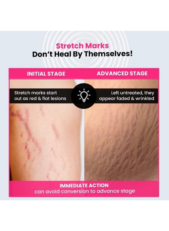 THRIVECO Stretch Marks Expert Serum Cream ; Combats And Improves Appearance Of New And Old Stretchmarks ; Powered By Striover Rosehip Oil And Squalane; Vegan And Crueltyfree ;30Ml - Image 4