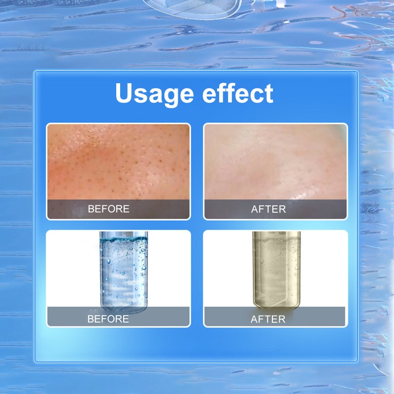 Blackhead Remover: White, 4 Adjustable Suction Levels, 6 Replaceable Heads - Portable, Long-Lasting Battery Pore Cleansing Device for At-Home Skincare, Travel Use - Image 4