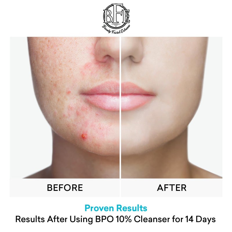 Beauty Facial Extreme Acne Face wash Treatment with Benzoyl Peroxide 10% - Fight Acne Blemishes on Contact for Cystic Breakouts, Oily Skin, Clogged Pores, Blackhead, Whitehead & Pimples. Achieve Clear Skin. - Image 5