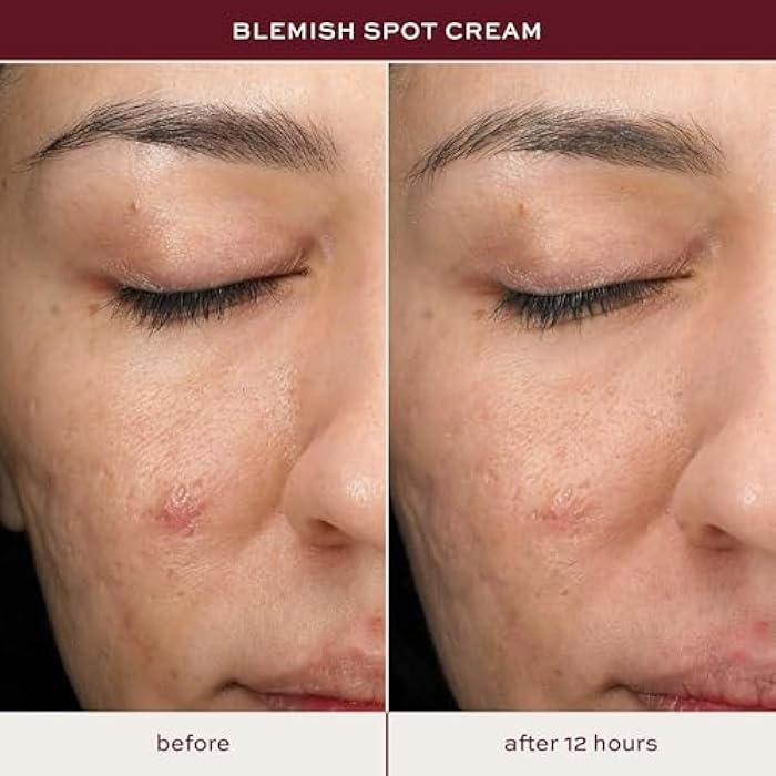 ITK Skincare Salicylic Acid Acne Spot Treatment for Face, Back & Body - Fast Active Acne Relief - Pimple Cream for Acne Prone Skin - Clear Blemishes Fast with Tea Tree Oil - 0.5oz - Image 4