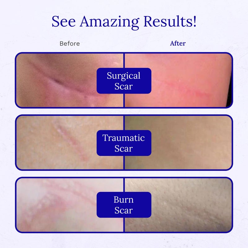 Rejuvaskin RejuvaSil Silicone Scar Gel, Scar Treatment for Surgical Scars, Burns, Keloids, Acne Scars on Face & Body, 0.33 ounce - Image 5