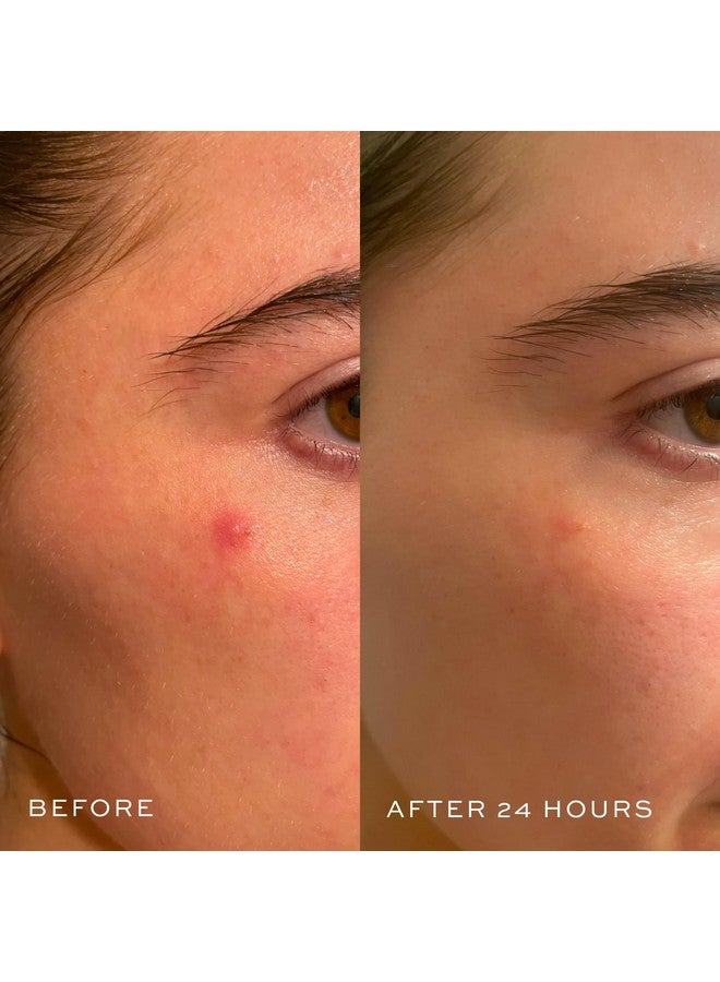 DIME Beauty Power Patch, 72 Count - Hydrocolloid Pimple Patches, Zit Spot and Blemish Aid with Salicylic Acid, Vitamin A, and Clove Oil - Image 5