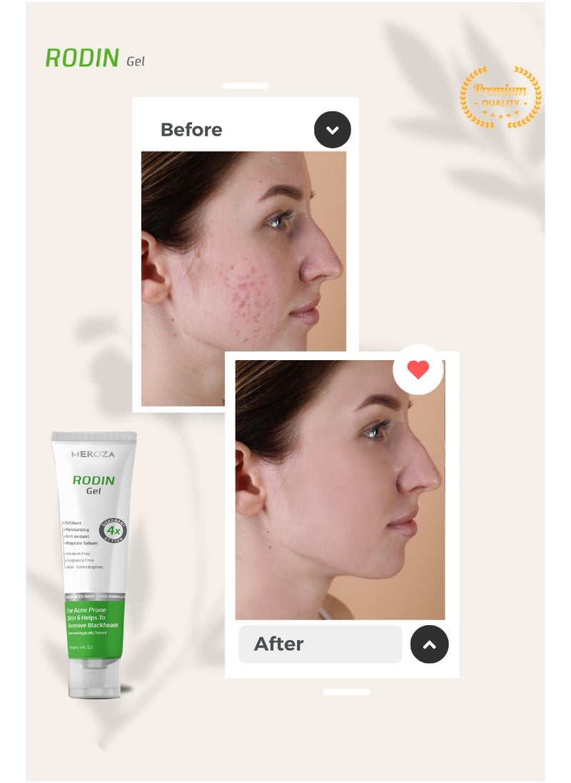 MEROZA - RODIN Anti Acne Gel 60 gm - Image 1