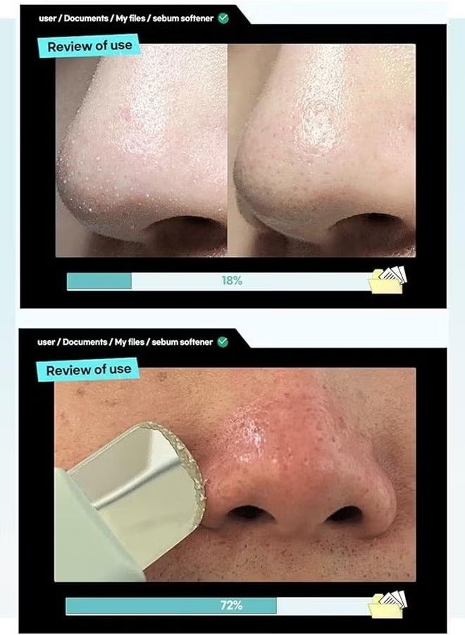 أيضا سوبر ذوبان الزهم مطهر 150g ، Defatliquoring مجمع اسيا تيكوسا استخراج البابايا استخراج الفاكهة ، وإزالة الرؤوس السوداء ، وذوبان الزهم مطهر ، تنظيف المسام - Image 4