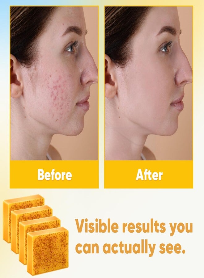 Treeroot 4 Pack Turmeric Soap, 100g Kojic Acid and Turmeric Soap Bar, Gently Clean the Face, Contains Retinol, Collagen, Vitamin C, Shea Butter, Used for Face & Body, SLS Free - Image 4