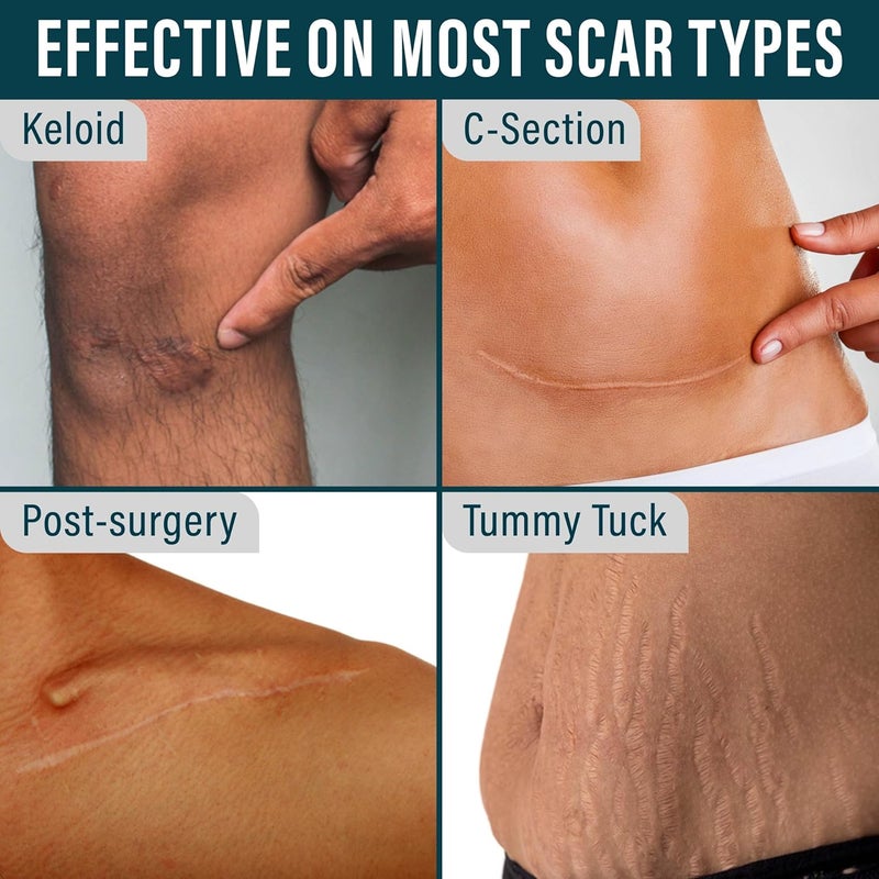 Nuvadermis شريط سيليكون لعلاج الندبات من نوفاديرميس وكريم مكثف للندبات ليلاً - مجموعة العناية الكاملة بالندبات للندبات الجراحية - Image 4