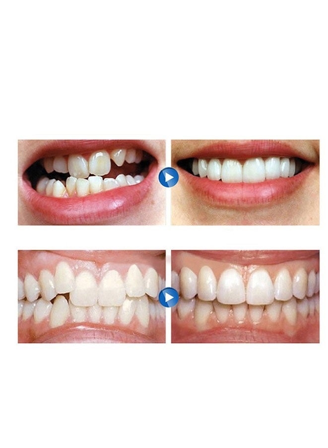 FASHION MANIA Braces aligners - Image 4