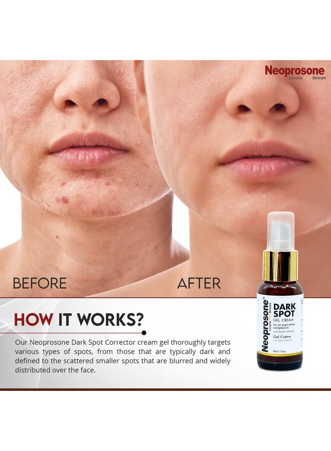 Neoprosone نيوبروسون، كريم جل للبقع الداكنة - 1 أونصة سائلة / 30 مل - كريم جل للوجه، يقلل من حب الشباب، بقع الشمس، بقع العمر على الوجه، الركب، المرفقين، اليدين، المناطق الخاصة - Image 4