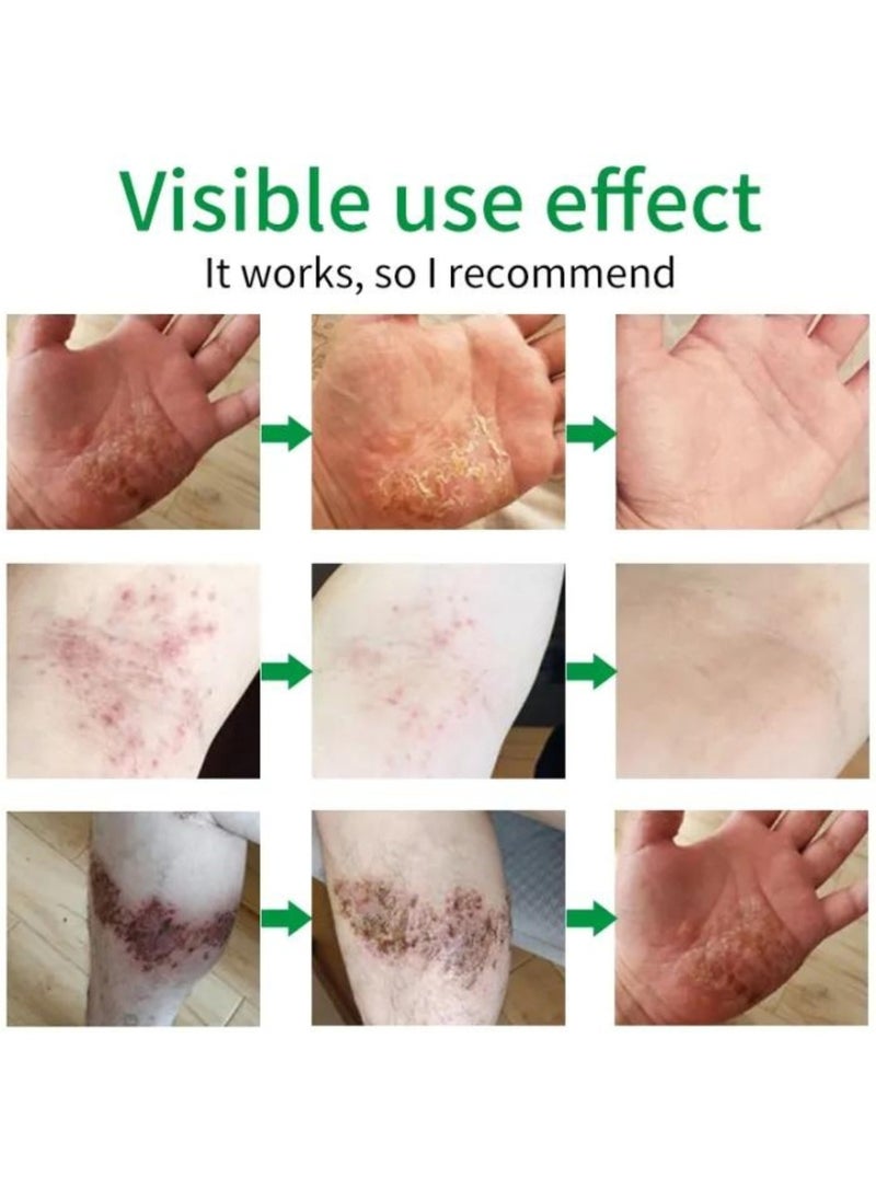 HEALMUSZ - Herbal Psoriasis Ointment Advanced Psoriasis Treatment Cream Antifungal Cream Maximum Strength Pain Relief Relieve Psoriasis Skin Itching and Inhibit Fungal Infection Psoriasis Treatment Cream 20g - Image 1