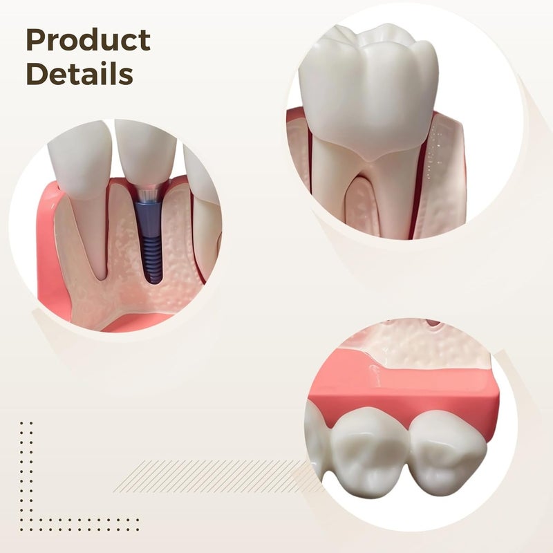 PVC Dental Training Model 4X Enlarged With Removable Crown And Implant For Clinical Instruction - Image 4