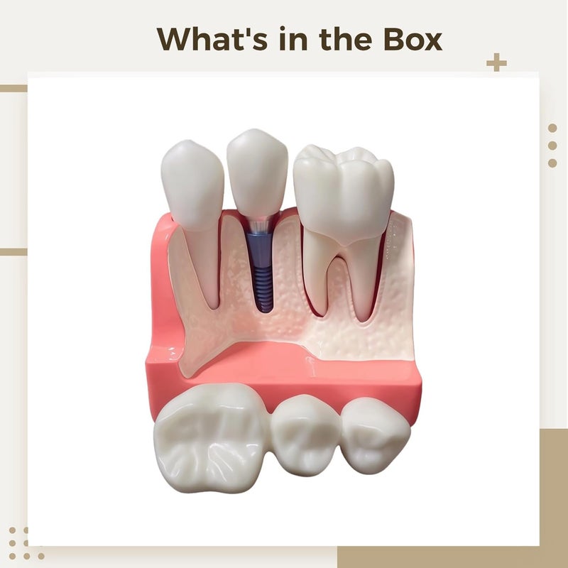 PVC Dental Training Model 4X Enlarged With Removable Crown And Implant For Clinical Instruction - Image 5