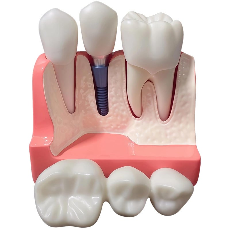 PVC Dental Training Model 4X Enlarged With Removable Crown And Implant For Clinical Instruction - Image 2
