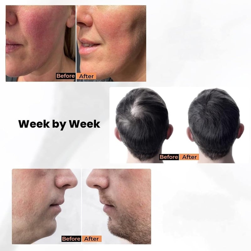 WeProve WeProve Derma Stamp For Hair Growth Titanium Coated Adjustable Needles Microneedling For Skin Repair Face Hair Beard Growth Reduces Acne Scars Safe Effective To Use - Image 4