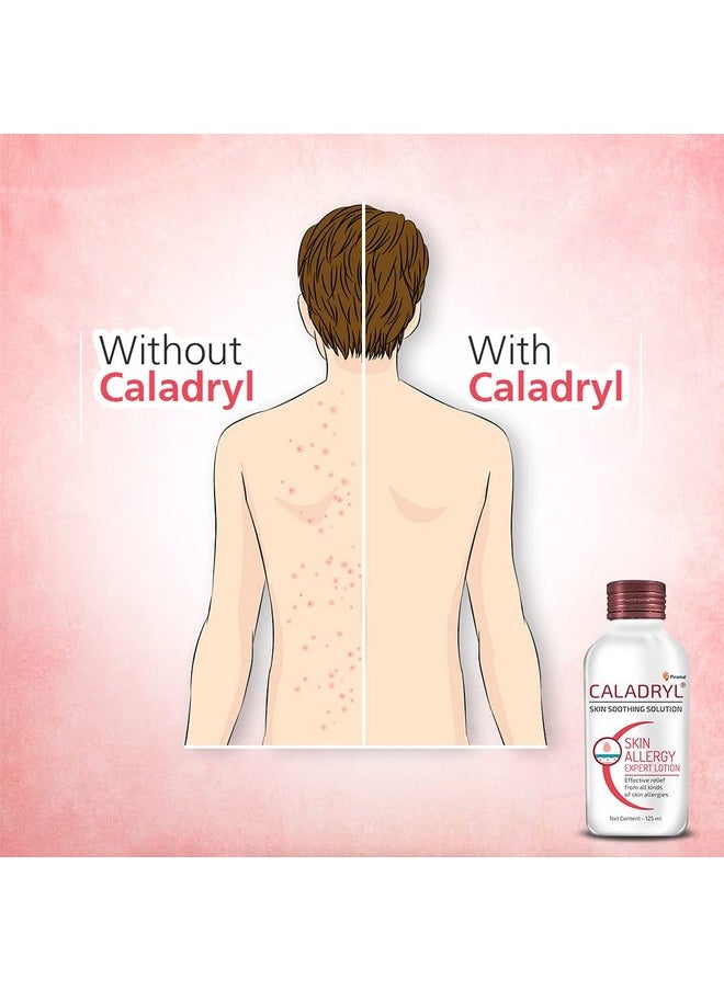 Caladryl Caladryl Skin Allergy Expert Lotion for relief from skin rashes, sunburn, prickly heat, insect bites - Pack of 3 (3 x 125 ml), White  - Image 3