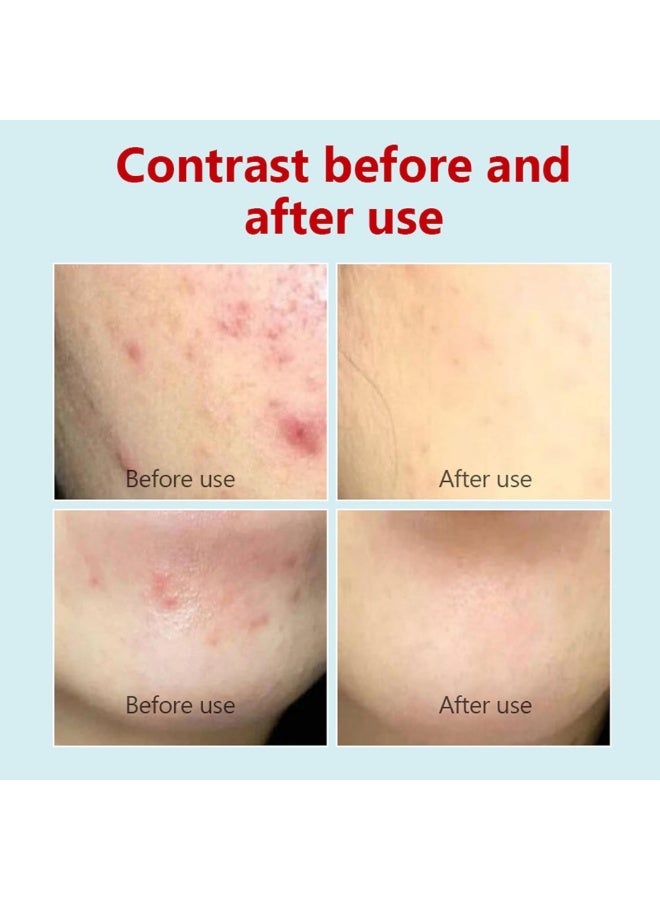 SERYNTH Acne Treatment Adapalene Gel 0.1% Acne Treatment Cream Acne Treatment Ointment Gel Acne Relief Cream Gentle Moisturizing Acne Removing Gel Pimple and Acne Removal Anti Acne Gel 20g - Image 5