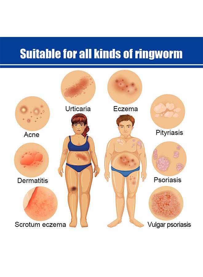 ساوث مون مرهم الصدفية المستخلص العشبي - مرهم جلدي مضاد للحكة عالي الجودة للحكة 20 جرام مرهم موضعي للتمريض - Image 5