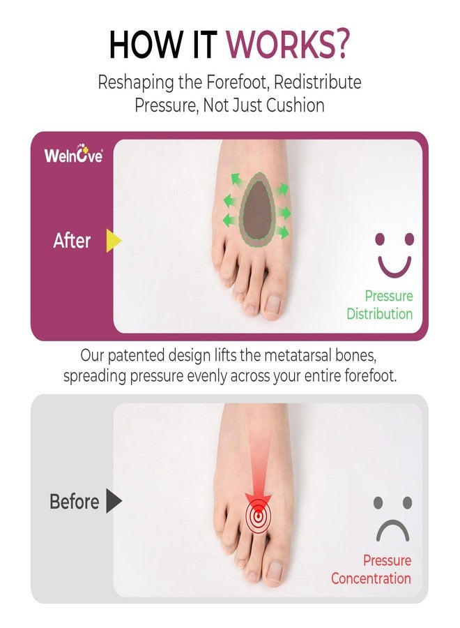Welnove Metatarsal Pads for Women Men - Drip-Shape - Leather Ball-of-Foot Cushions for Forefoot Support - Soft Ball of Foot Pads for Metatarsalgia, Morton’s Neuroma, Fit for High Heels,Shoes(Size：M) - Image 3
