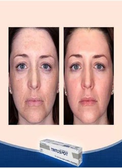 TRITOSPOT Tritospot Tropical Cream For Hyperpigmentation Problems for Men and Women  - Image 3