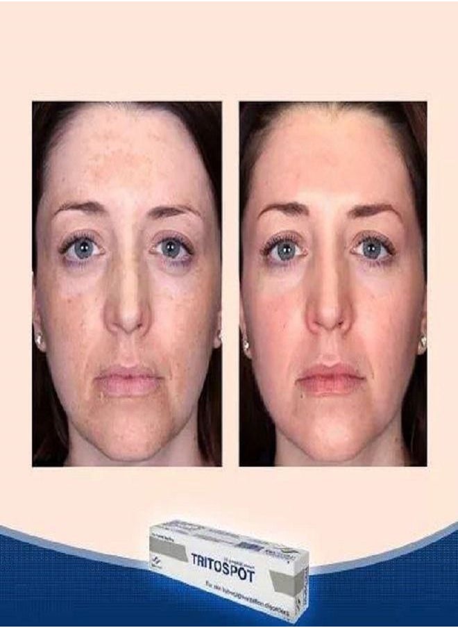 TRITOSPOT - Tritospot Tropical Cream For Hyperpigmentation Problems for Men and Women - Image 1