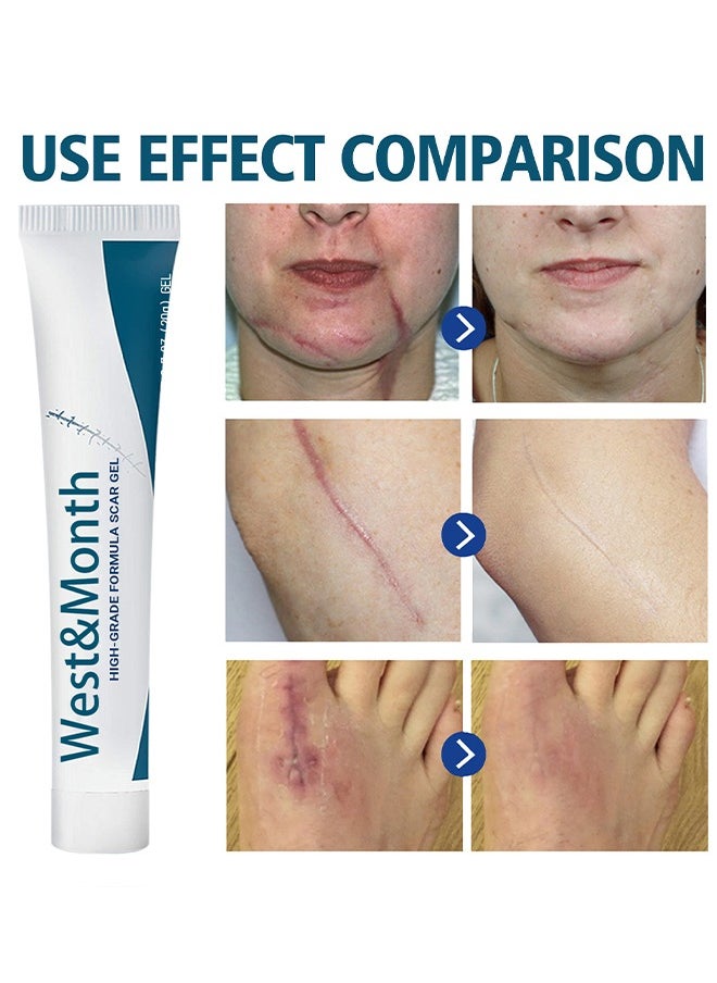 West&Month High-Grade Formula Scar Gel, Fade Scar Gel, Smooth Skin Care Gel,Scar Repair For Scar Pregnancy Surgery, 20g  - Image 2