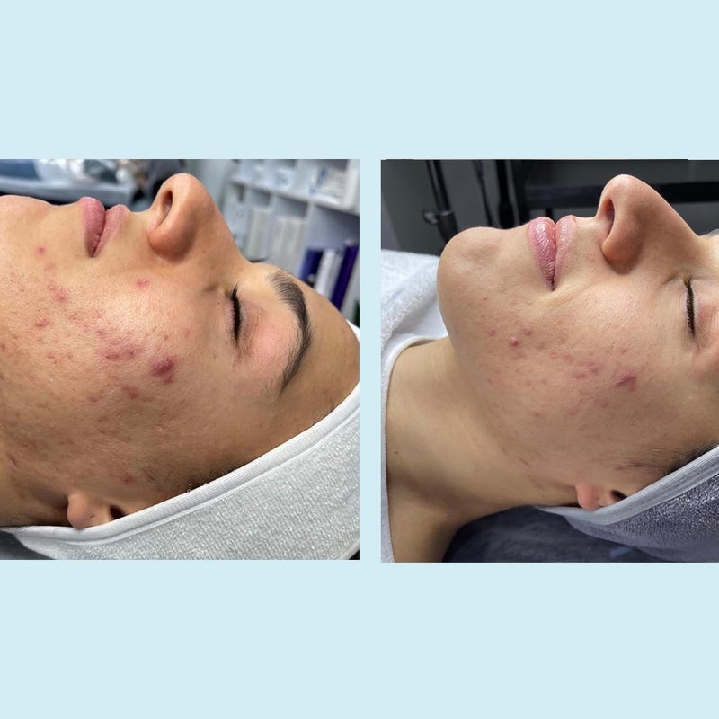 PERFECT IMAGE Salicylic Gel Chemical Peel - Enhanced with Green Tea Extract and Tea Tree Oil (20% Strength) - Image 5