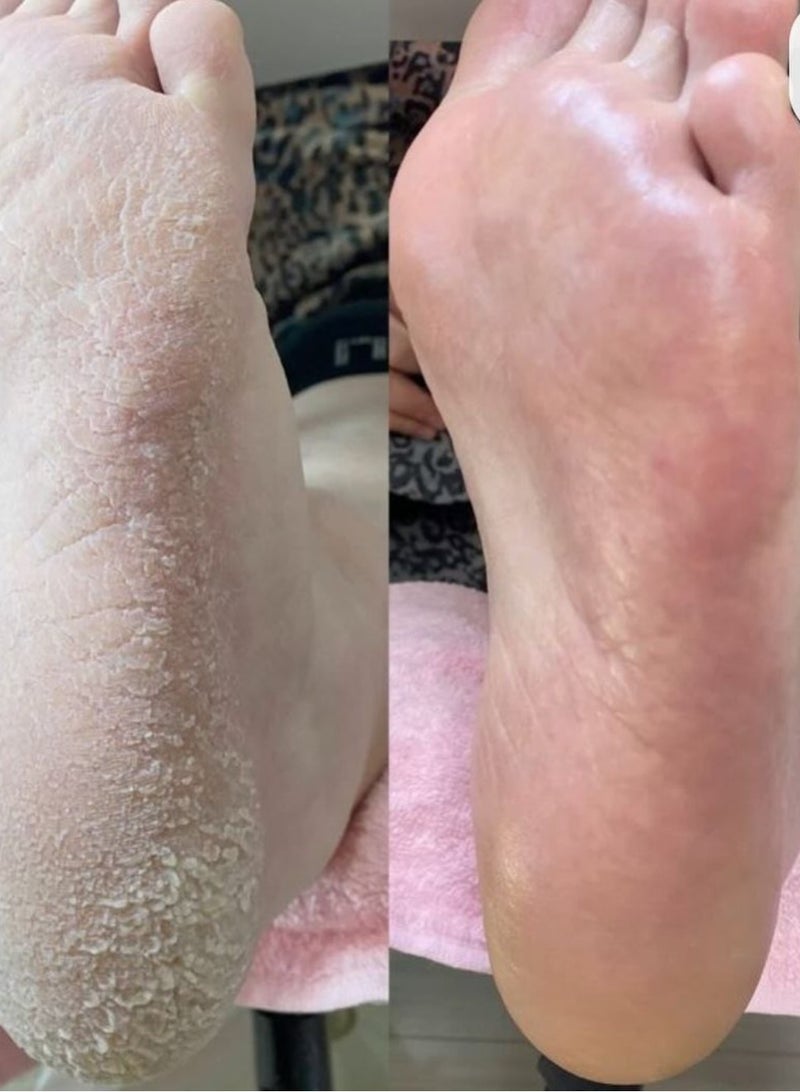 Painless Body Hair Removal Machine with Foot Heel Smoother – USB Rechargeable with Speed Control - Image 3