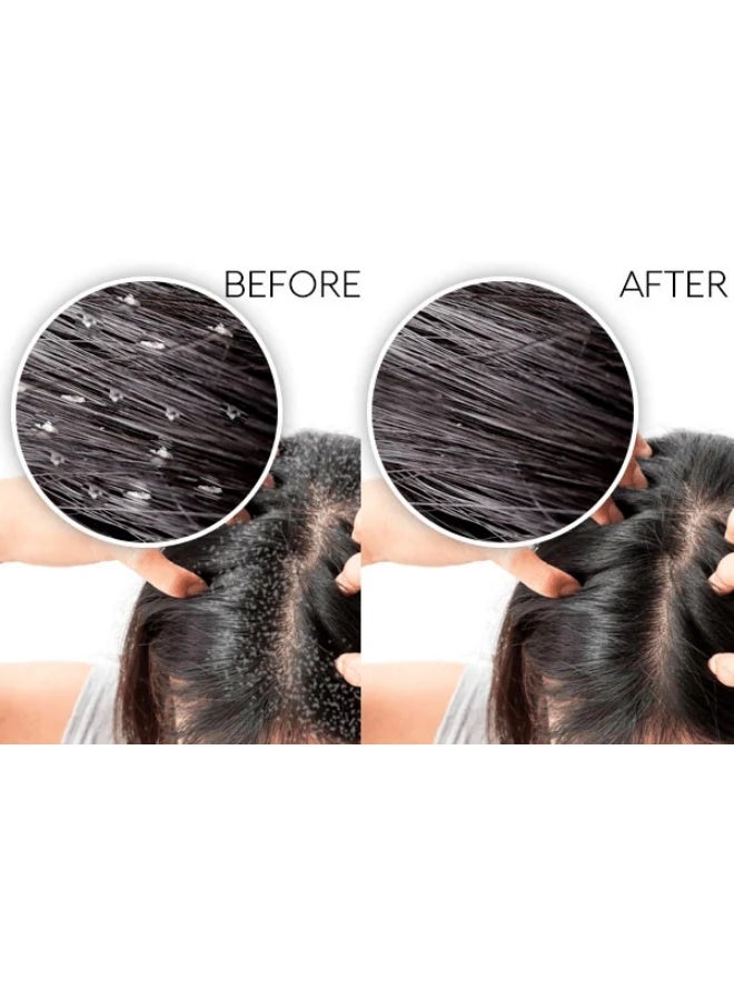 "GONE" Anti Dandruff Shampoo | Eliminates Dandruff & Itch From First Use + Contains Caffeine For Hair Growth & Natural Oils For Hydration - 175ml - Image 4
