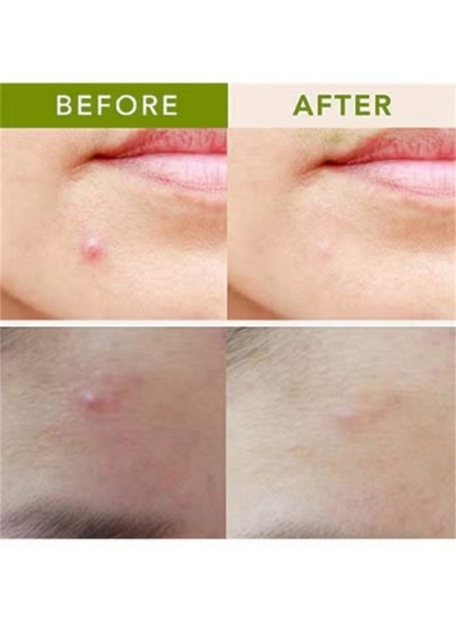 حياة مجنونة 9PCS تصحيحات حب الشباب Microneedles ، تصحيحات حبوب الشباب الوجه العناية بالبشرة ، تصحيحات حب الشباب الغير مرئية ، إزالة المرحلة المبكرة / الخفية / المكشوفة ، البثور ، البثور - Image 4