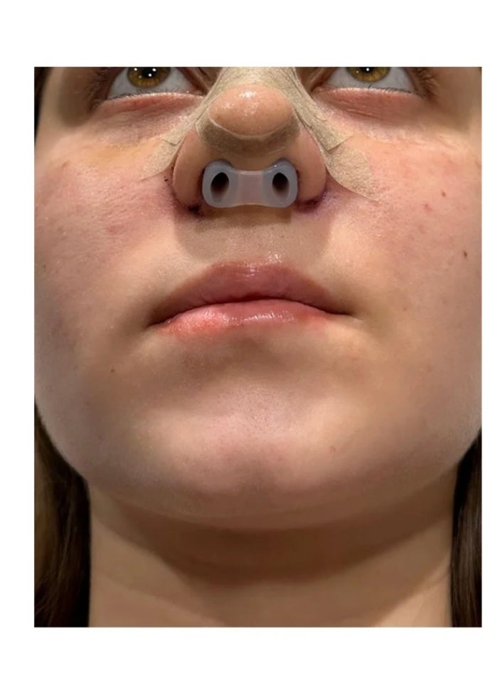 (رقم 5 رقم 6) مثبت فتحتي الأنف من السيليكون الصحي للوجه، وسادة أنف للجراحة، مثبت أنف لتجميل الأنف، مثبت للعمل الجراحي، دبوس أنف من السيليكون 0 - Image 4