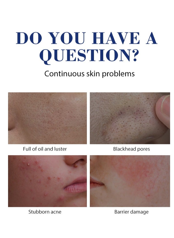 MOOYAM 2% Salicylic Acid Acne Cream, for Face and Body Deep Moisturizing Oil Control and Smoothing with Plant Salicylic Acid and Soothing Skin Suitable for Acne Skin 20g - Image 4