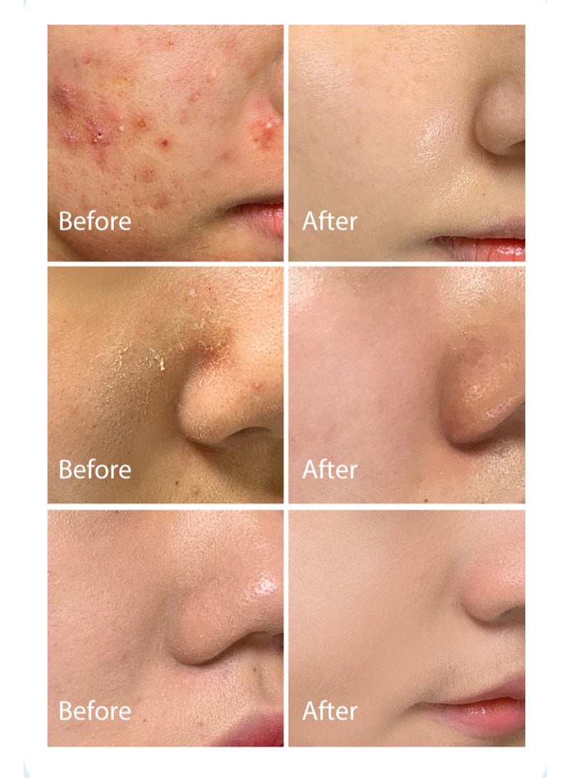 MOOYAM 2% Salicylic Acid Acne Cream, for Face and Body Deep Moisturizing Oil Control and Smoothing with Plant Salicylic Acid and Soothing Skin Suitable for Acne Skin 20g - Image 5