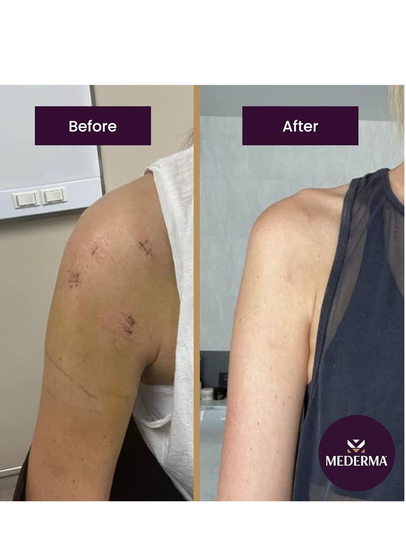 Mederma Advanced Scar Gel, Treats Old and New Scars, Reduces the Appearance of Scars from Acne, Stitches, Burns and More, 50 Grams