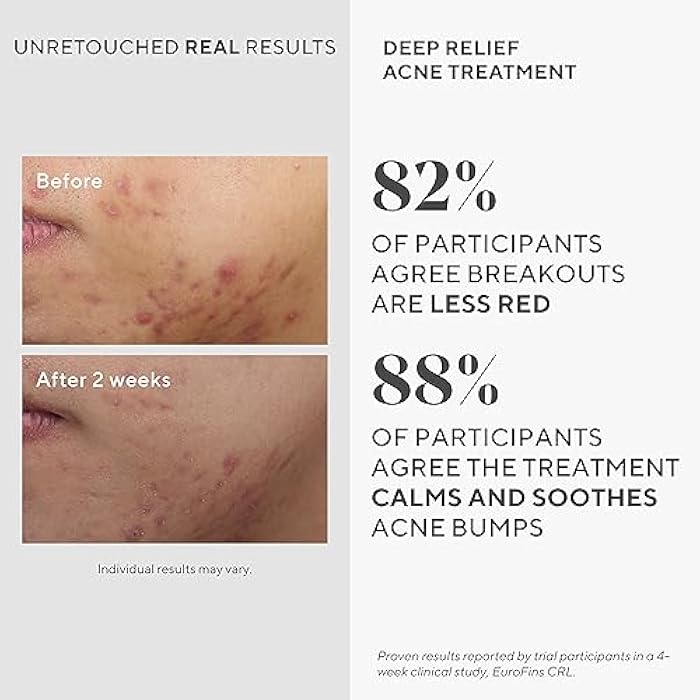 Murad Deep Relief Acne Treatment with 2% Salicylic Acid - Deep, Painful Acne Spot Treatment for Face – Redness Relief, Fast Acting Blemish Serum, Soothing Breakout Treatment - 1Fl Oz - Image 4