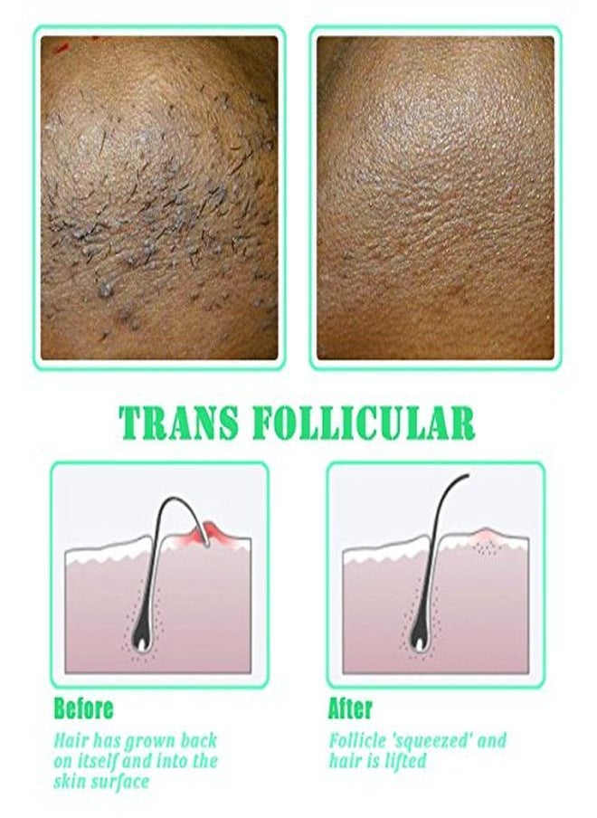 TailaiMei - Exfoliating Brush For Ingrown Hair Treatment - To Treat And Prevent Bikini Bumps, Razor Bumps - Silky Smooth Skin Solution For Men And Women - Image 1