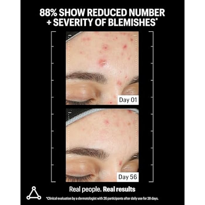 Allies of Skin Azelaic & Kojic Clarifying Face Serum | Clinically Proven for Acne & Blemish Prone Skin |10% Azelaic Acid Treats Pigmentation and Redness | Targets Pores & Uneven Skin Texture (1 Fl oz) - Image 4