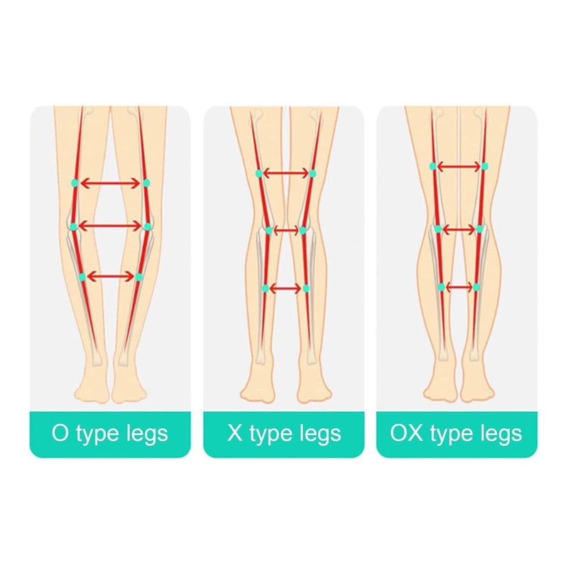 Luckam O/X Leg Type Correction Belt, Elasticity Leg Posture Corrector Band Unisex Teens Legs Bandage Strap, Lightweight Pediatric Straighten Belt for Day and Night Black (Large) - Image 4